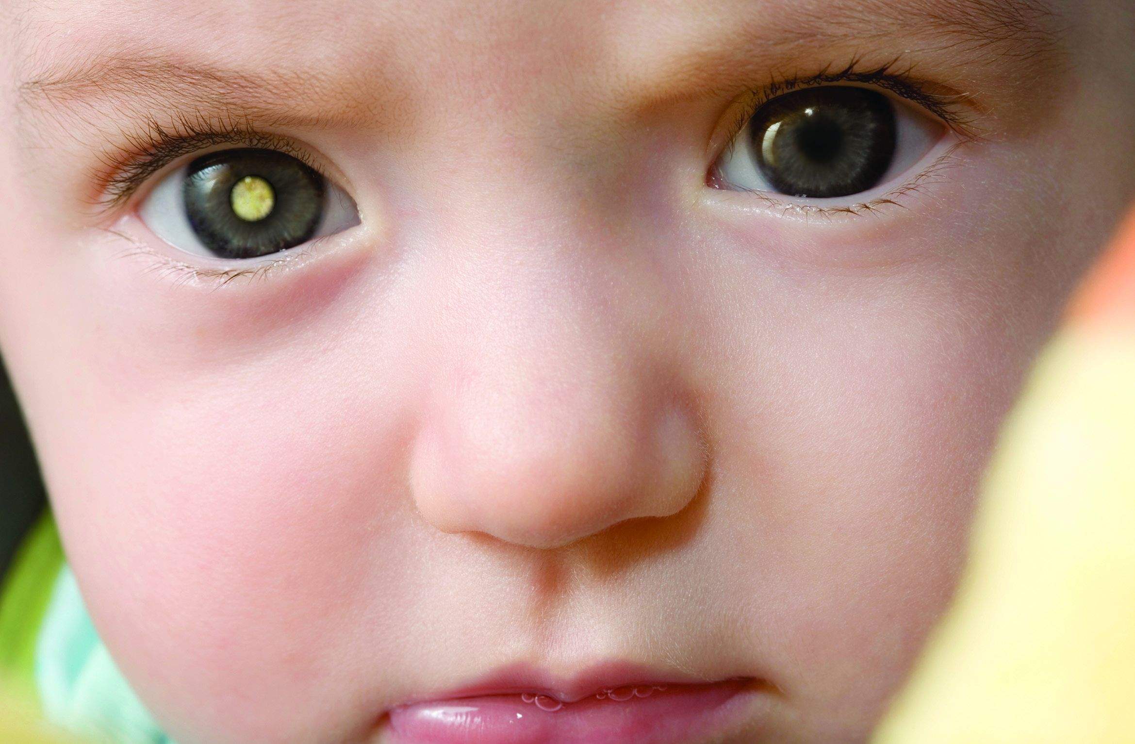Mancha esbranquiçada na pupila pode ser um dos indícios de retinoblastoma. Imagem: BioNews Texas