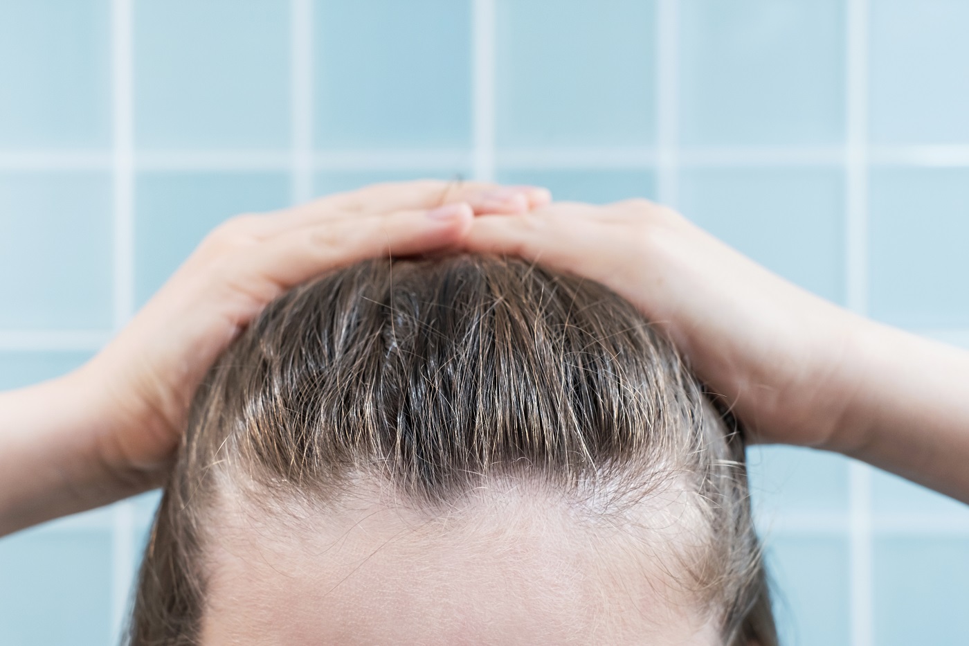 queda de cabelo infantil